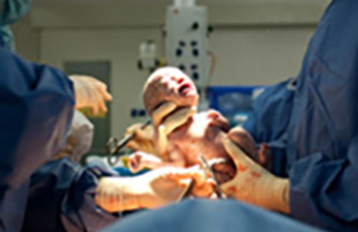 caesarean